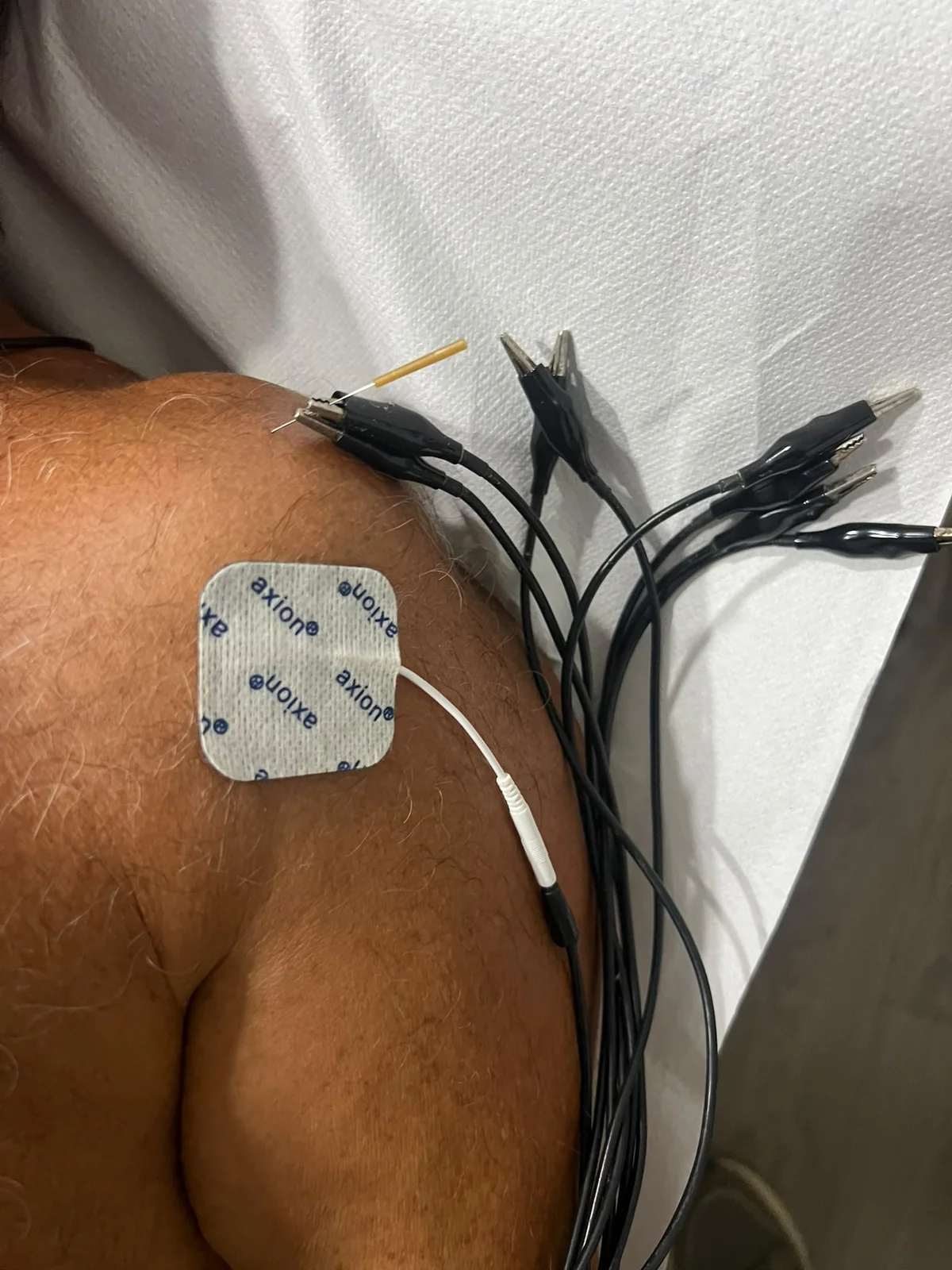 Bursitis subacromial de hombro tras caída en bicicleta - Clínica Ansar Jerez