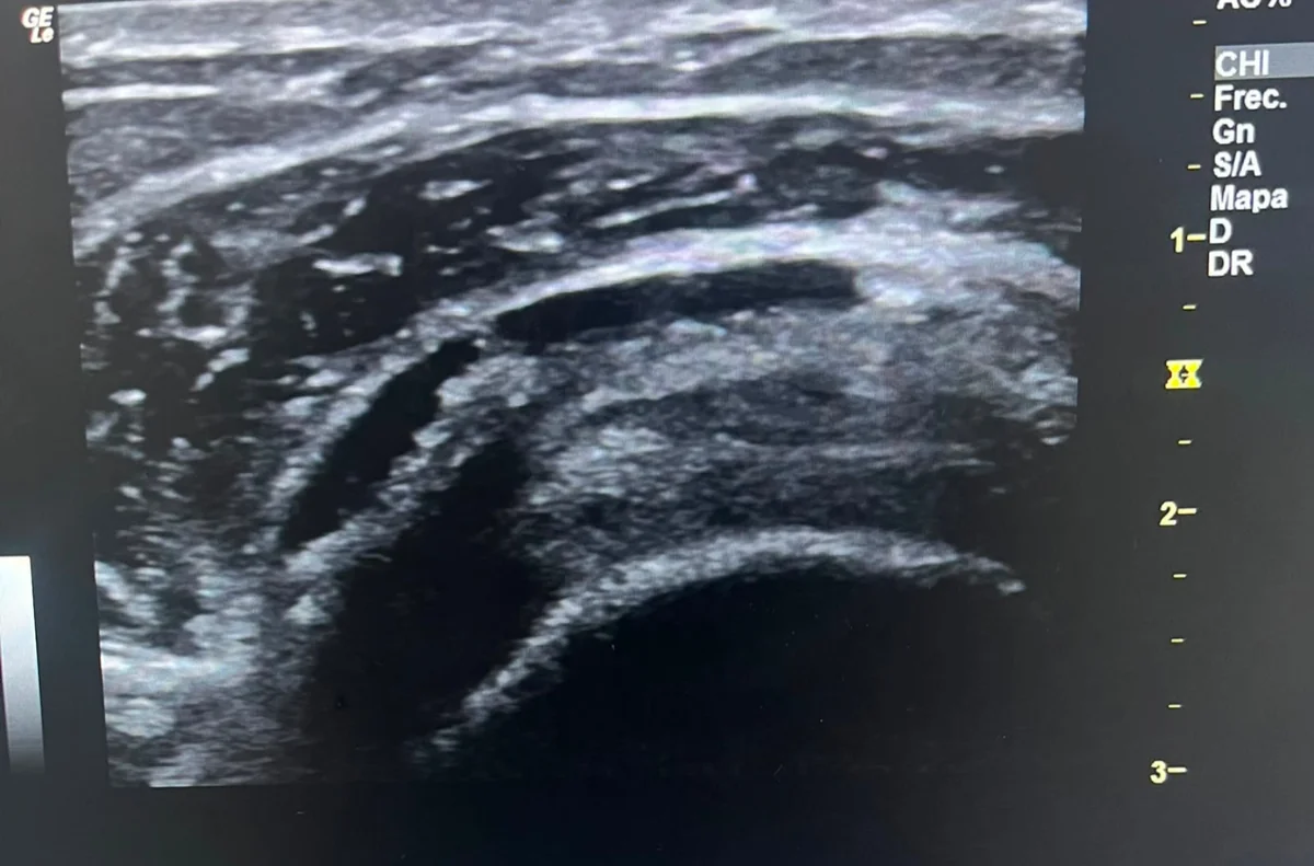 Ecografía de bursitis subacromial de hombro - diagnóstico por imagen en Clínica Ansar Jerez