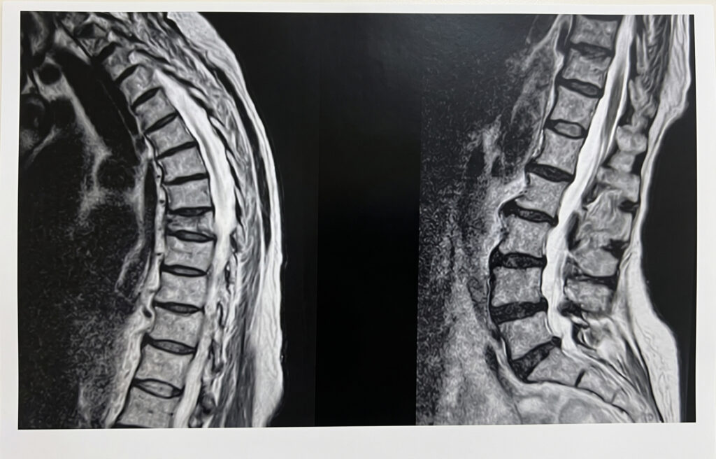 Resonancia magnética de columna dorsal mostrando fractura vertebral por osteoporosis